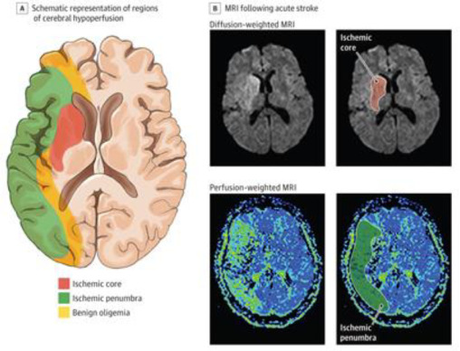 Brain Stroke Detection